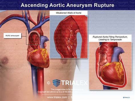 Ascending Aortic Aneurysm Rupture Trialquest Inc