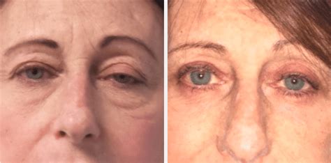 Ptosis Surgery Long Island Droopy Eyelid Treatment Long Island