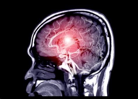 What Is A Brain Aneurysm And What Are The Causes Symptoms And