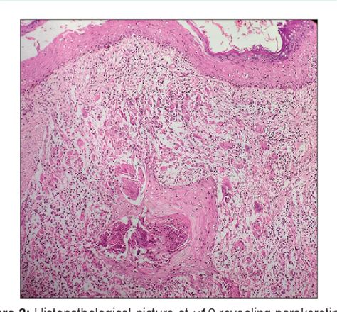 [pdf] Atypical Presentation Of Tuberculosis Semantic Scholar