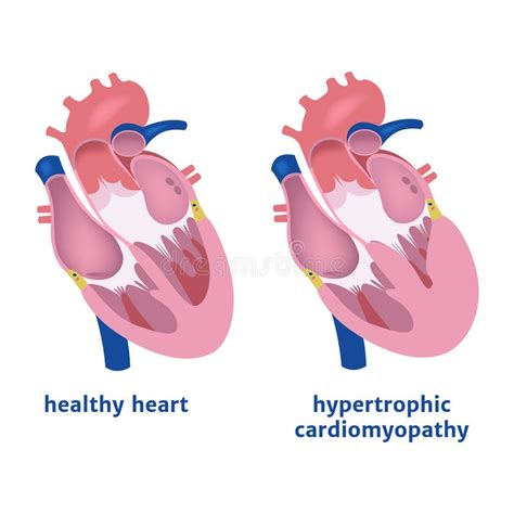 Hypertrophic Cardiomyopathy Occurs When The Muscle Cells Of The Heart