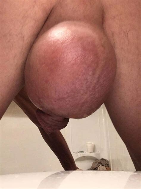 My Saline Pump Balls 1 Nude Pics XHamster