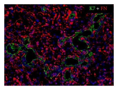 Partial Expression Of Some Mesenchymal Features By Ductular Reactive