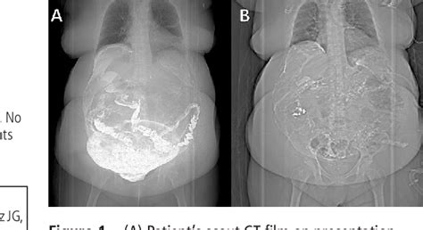 PDF Use Of Barium For Diagnosis Of Colonic Perforation Leads To