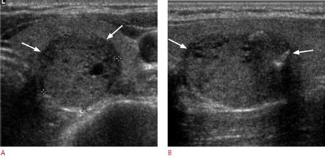 Ultrasonographic Imaging Of Papillary Thyroid Carcinoma Variants Pmc