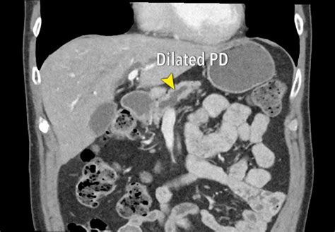 Pancreatic Carcinoma Ct