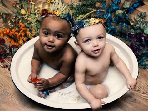 ‘pretty Rare Twin Sisters Born With Different Skin Colors Celebrate