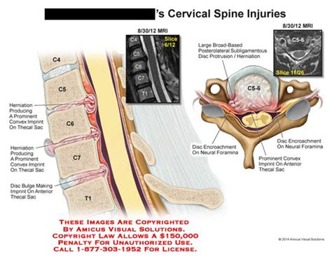 Amicus Illustration Of Amicusinjurycervicalspinec5c6c7t1