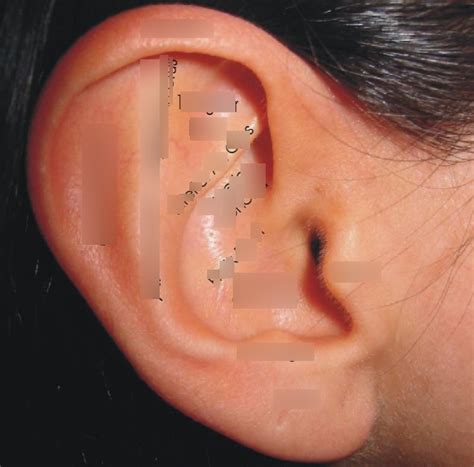 Asm Moxa Electroacupuncture Auricular Acu Diagram Quizlet