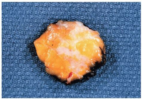 Invasive Ductal Carcinoma Gross