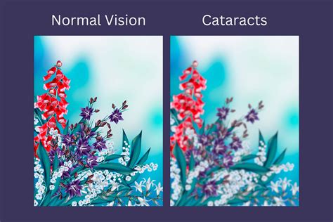 Understanding Cataracts Causes Symptoms And Treatment Iowa Eye Center