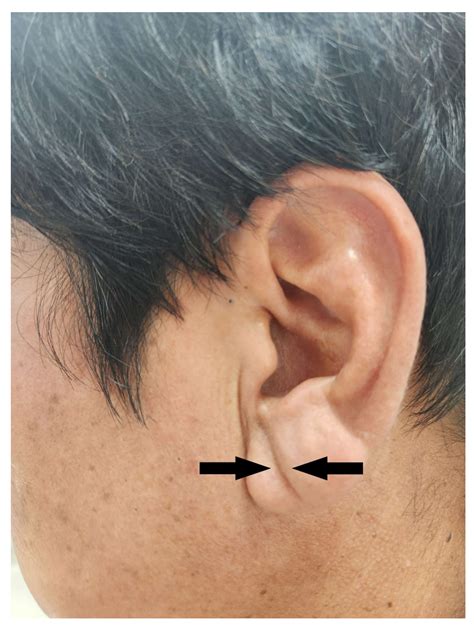 Association Of Diagonal Earlobe Crease With Risk Of Atrial Fibrillation