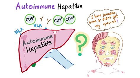 Autoimmune Hepatitis Lupoid Hepatitis Youtube