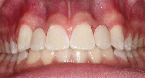 Resin Bonded Bridge Maryland Bridge Origins Dentistry