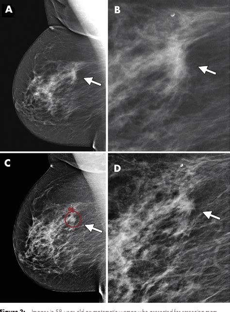 Figure From Artificial Intelligence For Mammography And Digital