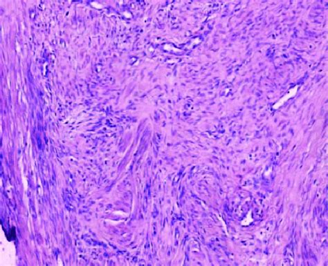 Low Power View Of Tumor Showing Moderately Differentiated Squamous Cell