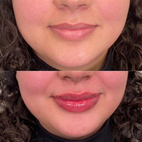 Lip Filler Full Syringe The Flawless Lab Scottsdale Arizona