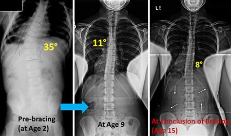 Adolescent Idiopathic Scoliosis Treatment And Surgery Nj And Nyc