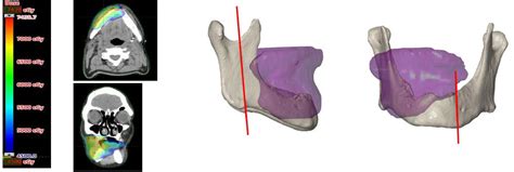 Frontiers A Novel Treatment Concept For Advanced Stage Mandibular Osteoradionecrosis Combining