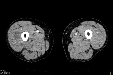 Sarcoma In Right Thigh And Vascular Tumor Thrombus As Well Vascular