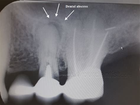 Dental Abscess X Ray