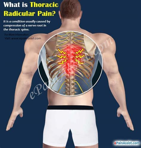 Thoracic Radiculopathy Symptoms Recipes