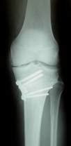 Knee osteotomy » Essex Knee Surgery