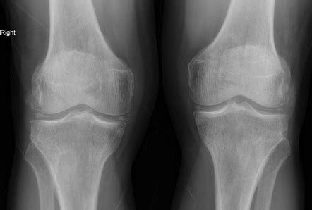 Chondrocalcinosis | Radiology Case | Radiopaedia.org