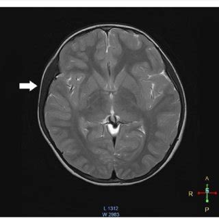 Isolated right temporalis muscle hypertrophy on a coronal MRI image ...