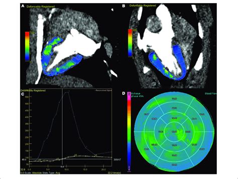 Dynamic Perfusion Acquisition At 70 KV Fused MBF Map And CT Images