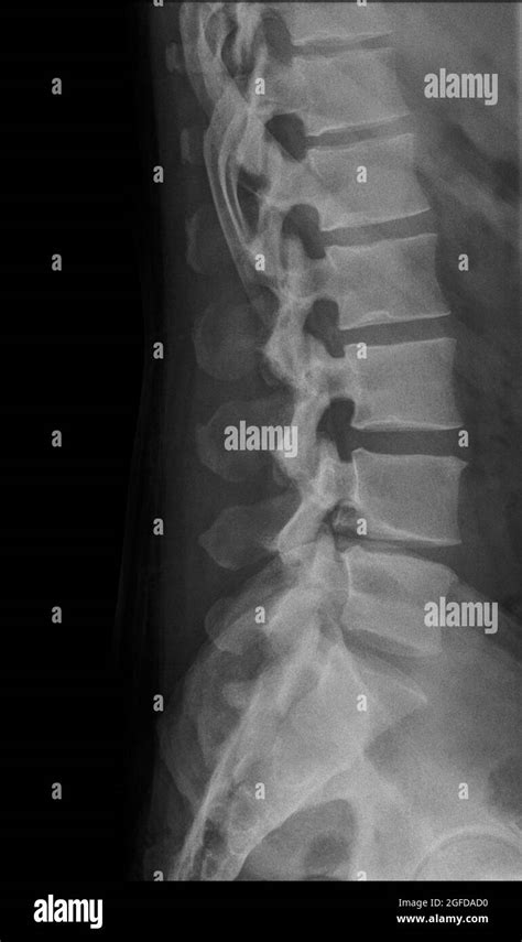 Human Lumbar Spine x-Ray side view Stock Photo - Alamy