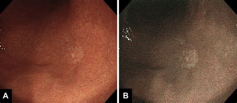 Detection Of Multiple Intramucosal Signet Ring Cell Carcinomas By White