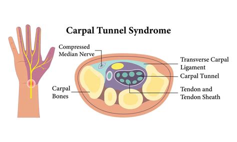 Carpal Tunnel Anatomy Diagram Illustration Design. 45592328 Vector Art ...