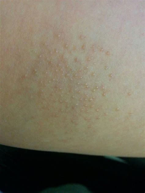 Any Tips For Follicular Eczema Skincareaddiction