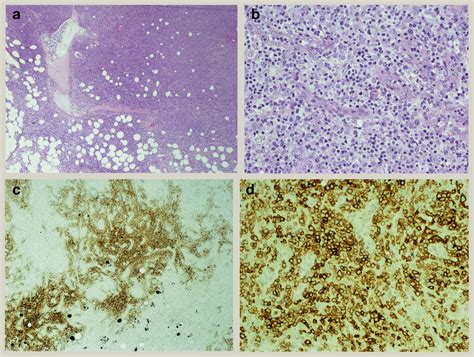 Nodal T Cell Lymphomas With A T Follicular Helper Cell Phenotype