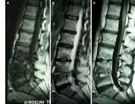 Mri Testing Showed Typical Alterations Of The Pyogenic Vertebral