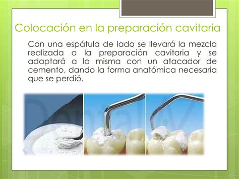 Manipulacion De Oxido De Zinc Y Eugenol 3