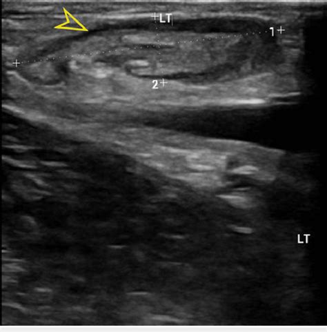 Correlated Inguinal ultrasound shows multiple prominent bilateral... | Download Scientific Diagram