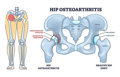 Hip Osteoarthritis Mr Jonathan White Consultant Orthopaedic Hip And Knee Surgeon Fitzwilliam