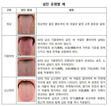 코로나19 후유증 한의치료는 어떻게 뉴스 한의신문