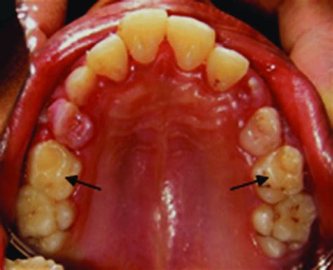 Supernumerary Cusps On Deciduous Second Molar Download Scientific Diagram