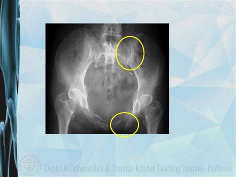 Classification Of Pelvic Fracture