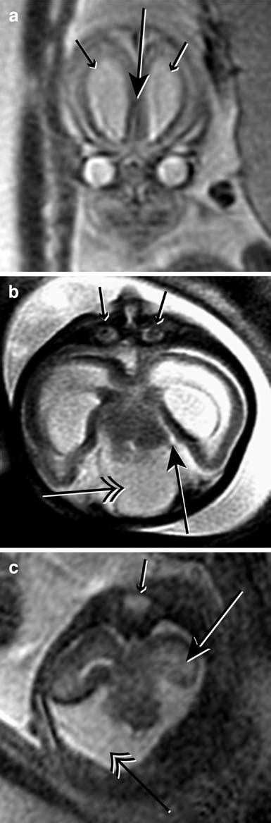 Hypotelorism. a Coronal MR image at 21.7 weeks shows mild hypotelorism ...