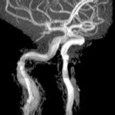 Stat X Carotid Artery Lesion Flashcards Quizlet