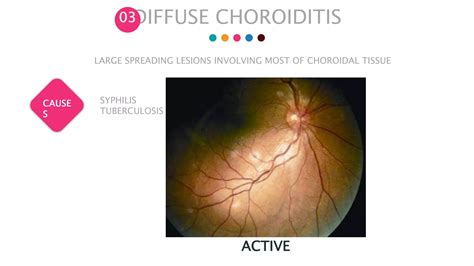 Posterior Uveitis Ppt