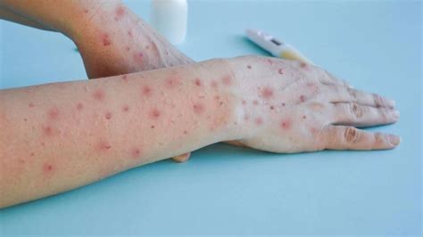 Explainer Smallpox और Chickenpox स कस तरह अलग ह Mpox कस कर सकत