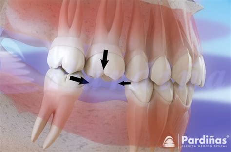 Do You Have Missing Teeth Methods Of Tooth Replacement Cl Nica