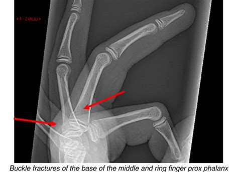 NHSGGC Hand And Finger Fractures