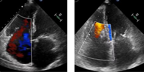 Pascal Device Works Well For Tricuspid Regurgitation In Commercial