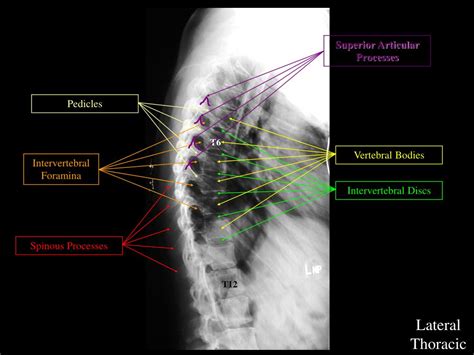 Ppt Normal Radiographic Spinal Anatomy Powerpoint Presentation Free Download Id 6535166